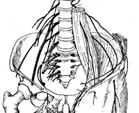 Lumbosacrális plexitis - okai, tünetei, diagnózisa és kezelése