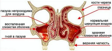 Parietal sinuzita ce este, simptomele si tratamentul de remedii populare