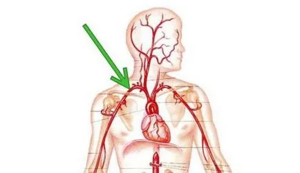 Simptome și prim ajutor pentru sângerare arterială