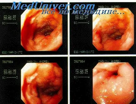 ulcer perforat