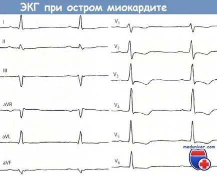 Jelek szívizomgyulladás az EKG