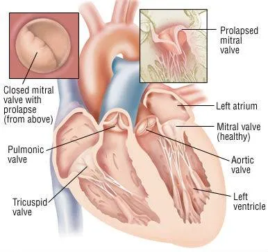 Simptomele mitrala prolaps, cauzele și diagnosticare