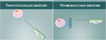 A comb közötti rész (transperineal) prosztata biopszia altatásban