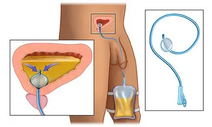 Biopsia picioare (transperineal) prostată sub anestezie