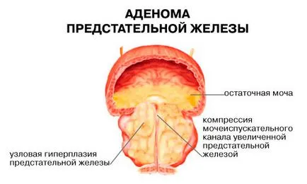 Pietrele din prostata pentru a trata