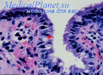 Rezultatul Soiurile bolilor infecțioase