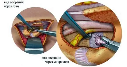 Reabilitarea după îndepărtarea coloanei vertebrale lombare hernie