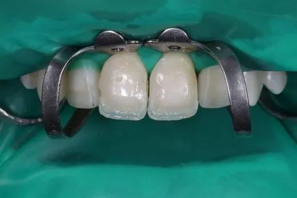 Planul de reabilitare a pacientului tratament ortodontic - terapie - știri și articole despre stomatologie