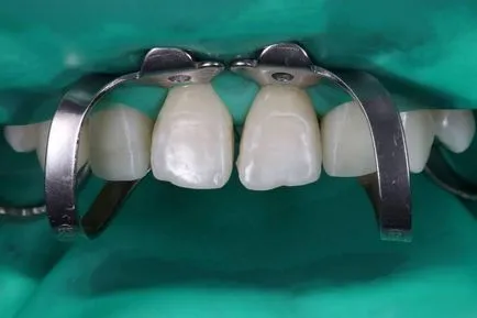 Planul de reabilitare a pacientului tratament ortodontic - terapie - știri și articole despre stomatologie