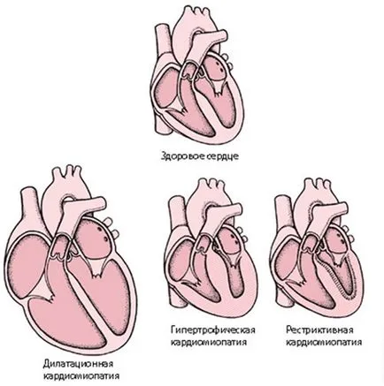 Рестриктивна кардиомиопатия (първична или вторична) симптоми, причини и лечение