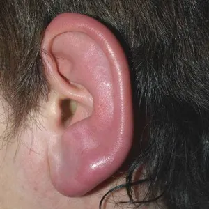 Еризипел лечение ухо, симптоми и снимки