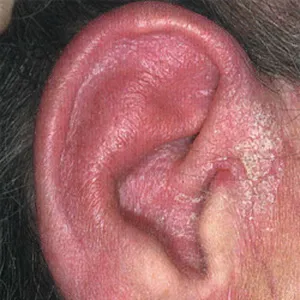 Orbánc fül kezelés, a tünetek és fotók