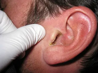 Orbánc fül kezelés, a tünetek és fotók