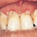 sínezés fogak periodontitis, fogászati