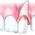 atele dinți cu periodontita, dentare