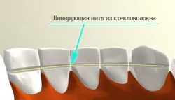 Sínbe periodontitissel Moszkva, overlay gumiabroncsok a fogakon