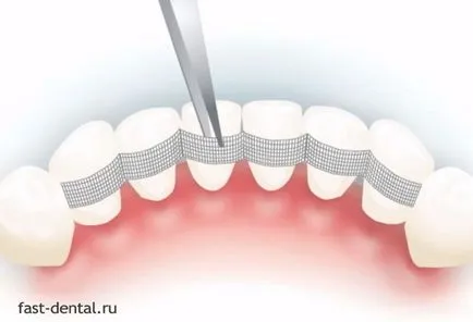 atele dinți cu periodontita, dentare