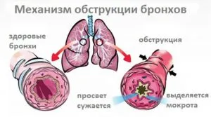 Симптоми, диагностика и лечение на обструктивен бронхит