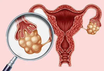 Симптомите на кисти на яйчниците при жените, усложнения