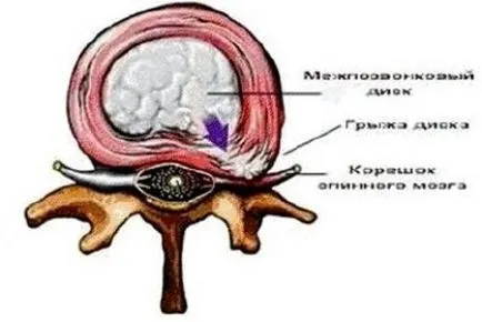 Симптомите на лумбалните херния