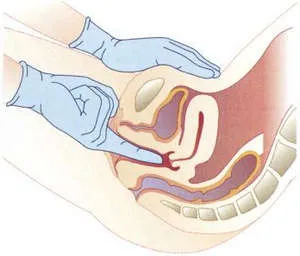 Simptomele de prolaps uterin si colul uterin, chirurgicale si tratament conservator