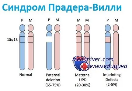 Prader-Willi szindróma újszülöttekben - okok, diagnosztikai