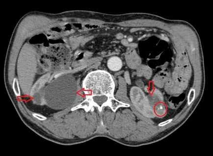 Sinus chist al rinichiului stâng - caracteristici și prevenirea patologiei
