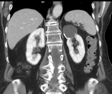 Sinus chist al rinichiului stâng - caracteristici și prevenirea patologiei
