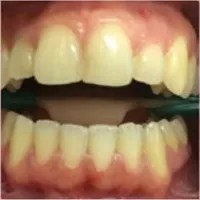 Усмивки клиника - професионални избелване на зъбите на достъпни цени