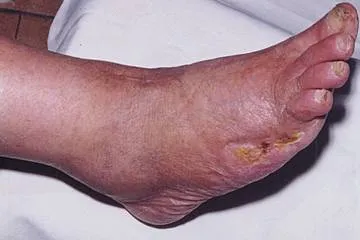 piciorul Charcot în dezvoltarea diabetului zaharat, simptome, tratament