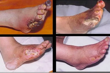 piciorul Charcot în dezvoltarea diabetului zaharat, simptome, tratament