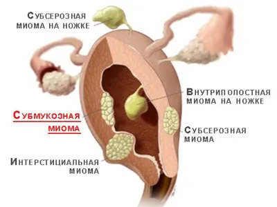 nyálkahártya alatti méh fibroid kezelés műtét nélkül