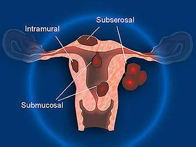 nyálkahártya alatti méh fibroid kezelés műtét nélkül