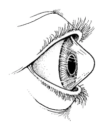 Keratoconus - diagnostic și tratament la centrul Fedorova