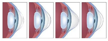 Keratoconus corneei - cauzele, amploarea și tratamentul (chirurgie, clinica) - site-ul web