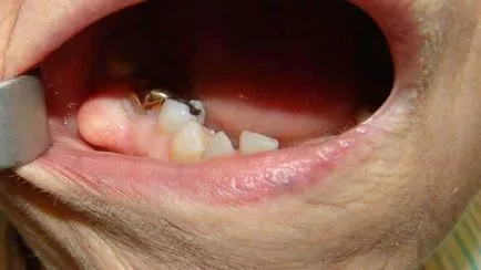 Киста в снимката на устата, лечение, как да се диагностицира
