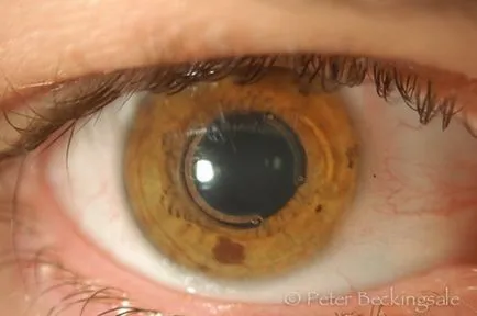 Keratoconus - diagnostic și tratament la centrul Fedorova