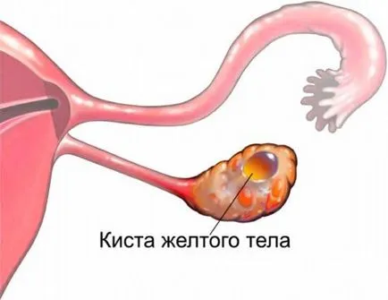 Chist a corpului galben ovar ceea ce este, simptomele si tratamentul acesteia