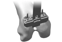 Tehnologia artroplastia de genunchi persona de la compania Zimmer, clinica doctor