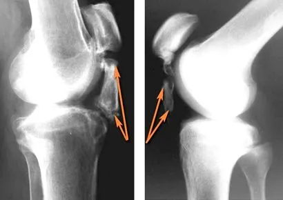 Ínhüvelygyulladás patellaín