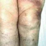 Thrombophlebitis okok, klinikai tünetek, kezelés - Medical Journal