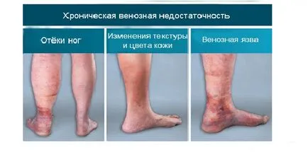 Trofikus fekélyek a thrombophlebitis - tünetek és kezelés