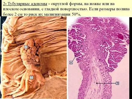 тубуларен аденом