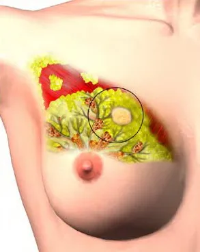 Eliminarea fibroadenoame mamare, t Clinica