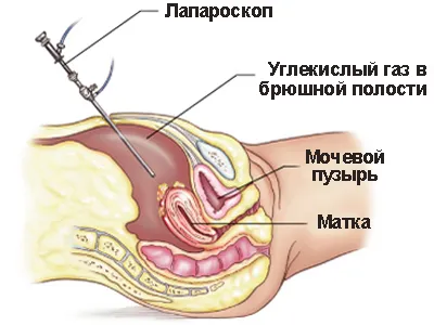 Méheltávolítás laparoszkópos indikációk, előkészítése