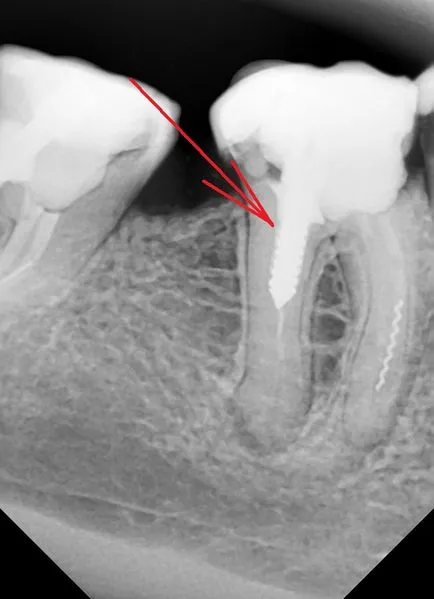 Премахване на анкерен болт от канала на зъба