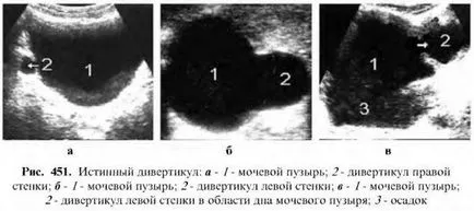 Ултразвуково изследване на пикочния мехур 1