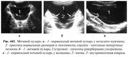 Examinarea cu ultrasunete a vezicii urinare 1