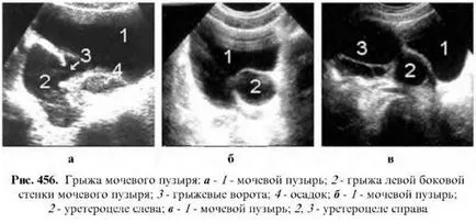 Ултразвуково изследване на пикочния мехур 1