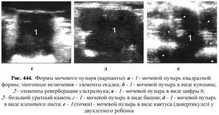 Examinarea cu ultrasunete a vezicii urinare 1